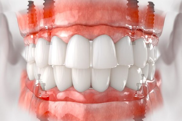 All-on-4 Implants