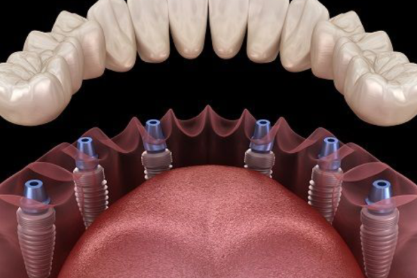 All-on-6 Implants