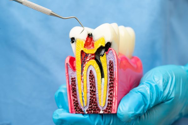 Asian dentist holding dental implant, artificial tooth roots into jaw, root canal of dental treatment, gum disease, teeth model for dentist.