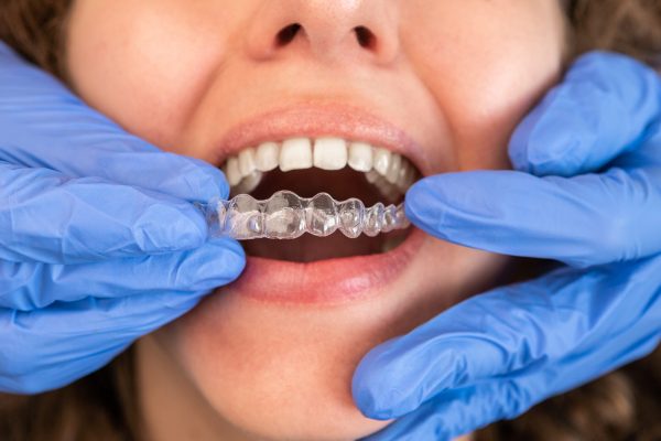 Dentist in gloves applying invisible aligner on female patient teeth at modern clinic. Orthodontic removable straighteners in dentist office. Dental treatment concept.