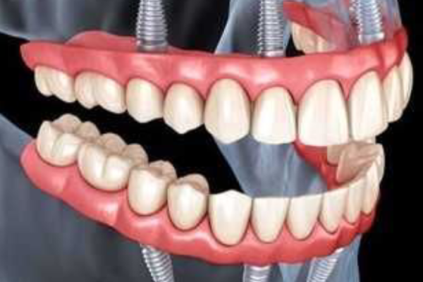 full mouth implants